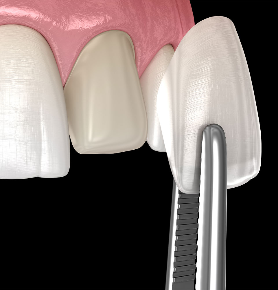 Porcelain Veneers – Anderson Dental Phoenix