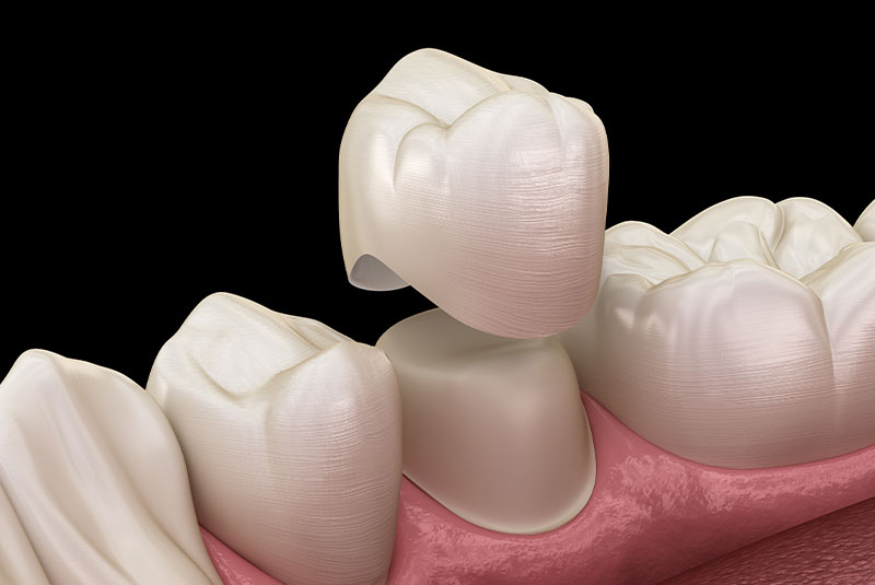 Dental crowns and bridges