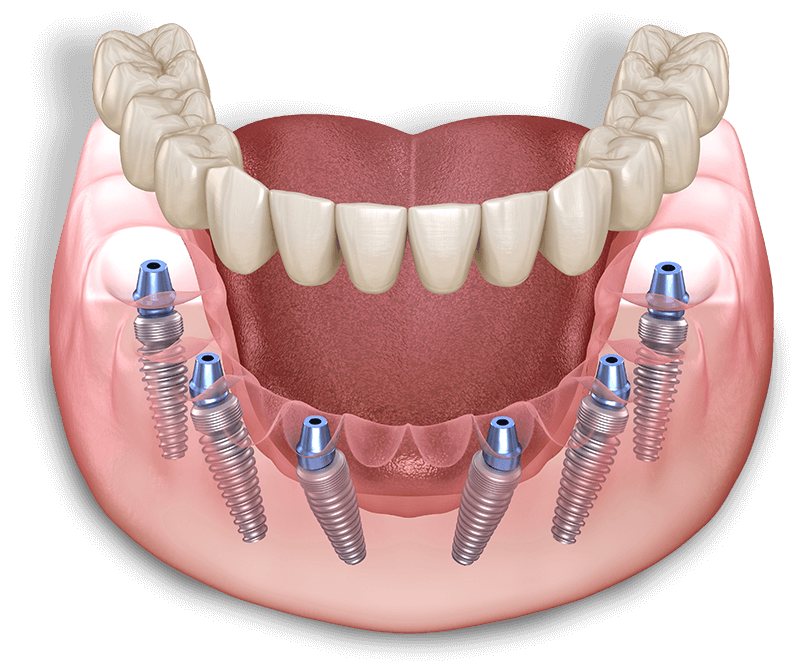 full arch implant model illustration