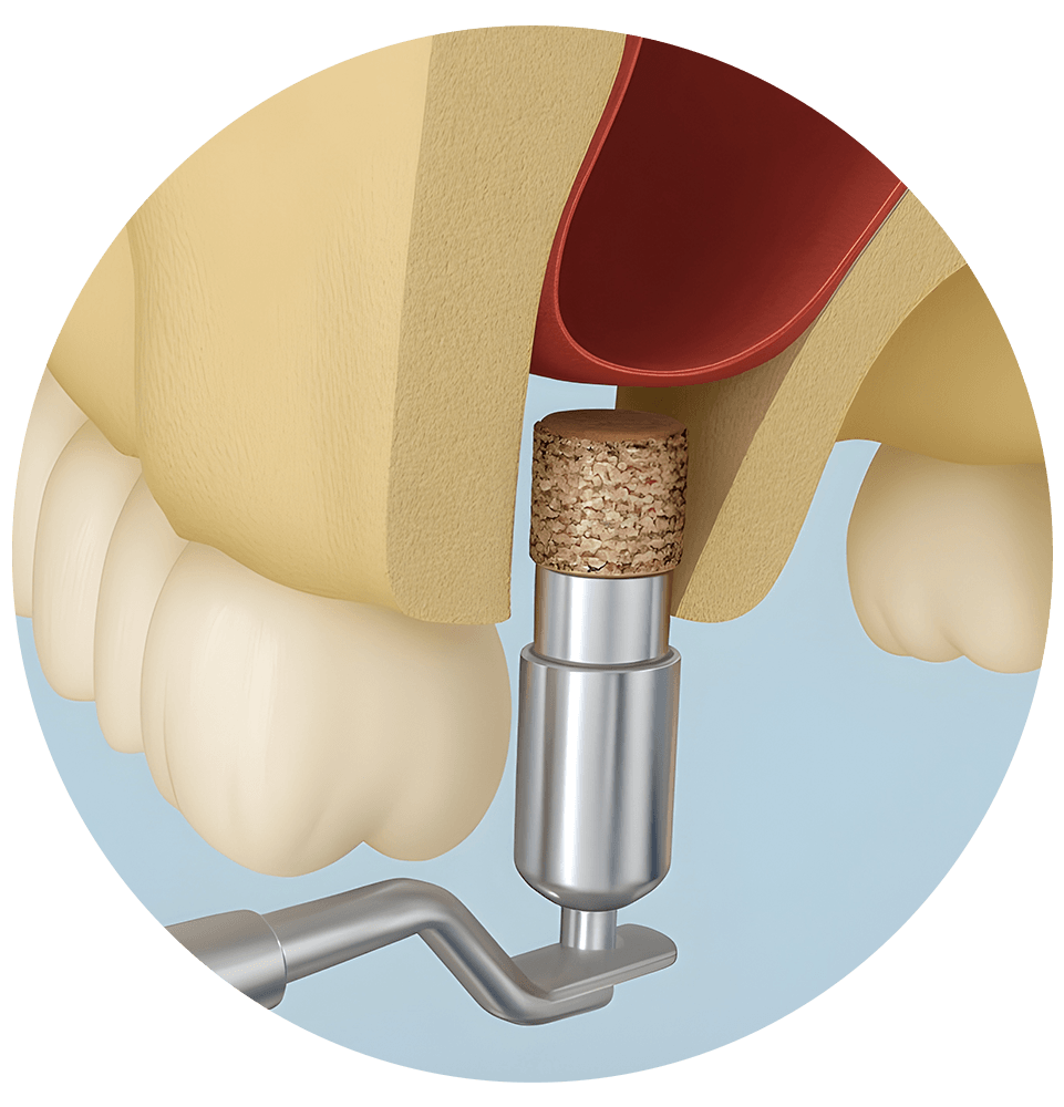 illustration of sinus lift procedure