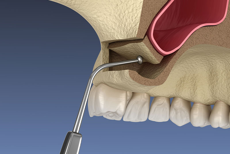Sinus Lift Surgery - Moving sinus membrane. 3D illustration