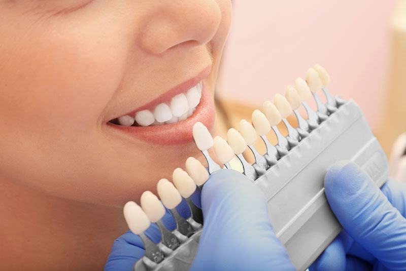 Tooth-colored composite fillings