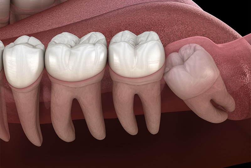Wisdom Tooth Extractions Phoenix, AZ | Anderson Dental